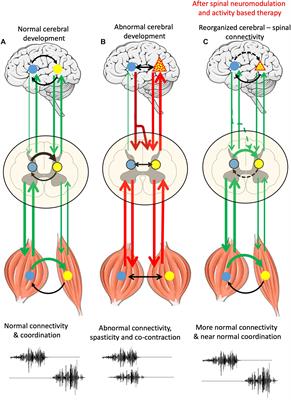 Engaging Spinal Networks to Mitigate Supraspinal Dysfunction After CP